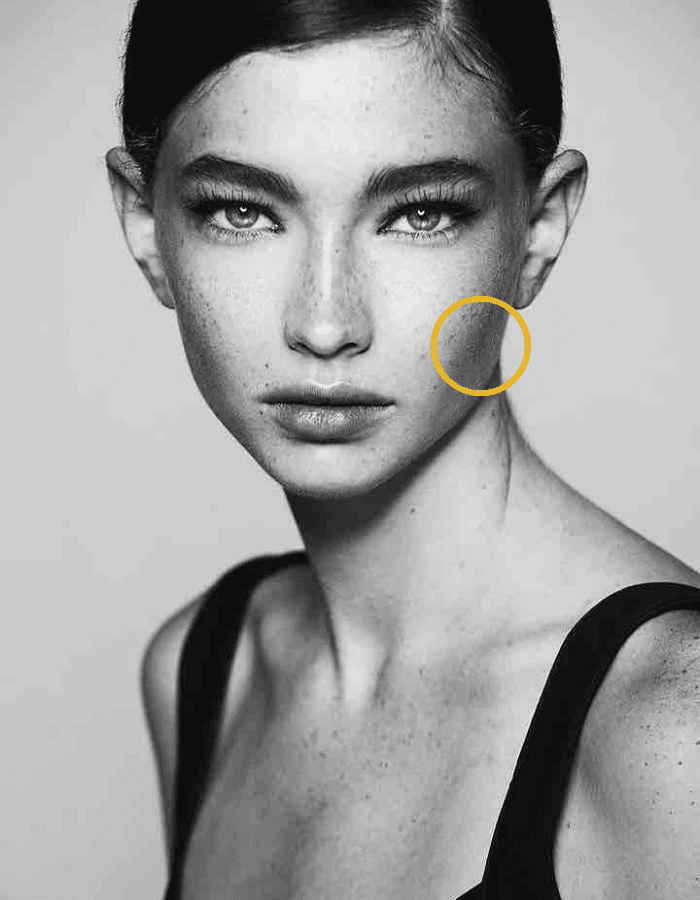 Brunette mit Sommersprossen Frau mit Kreismarkierung im Bereich Bruxismus