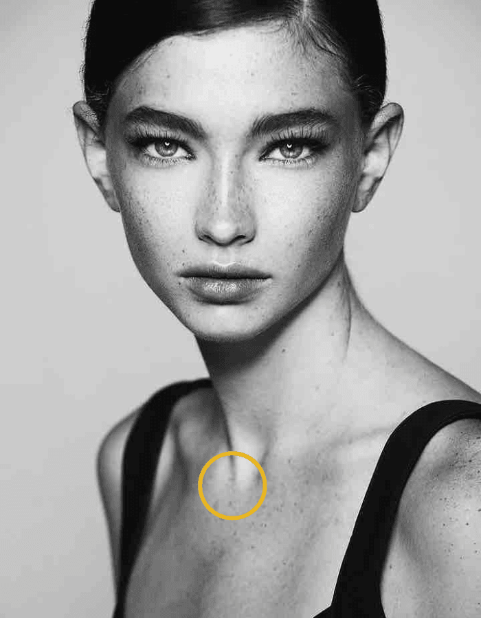 Brunette mit Sommersprossen Frau mit Kreismarkierung im Bereich Hals und Dekolteeunterspritzung