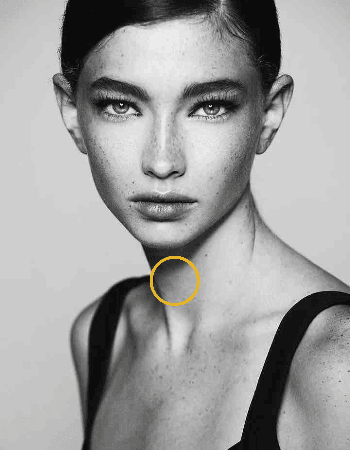 Brunette mit Sommersprossen Frau mit Kreismarkierung im Bereich Halsstraffung